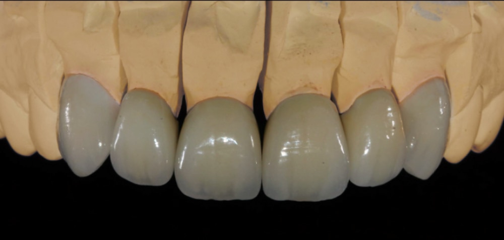 Zirconia Ultra restorative example