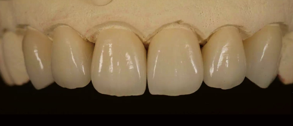 IPS e.max restorative example
