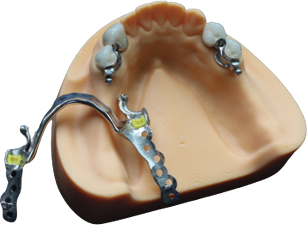Locator-style removable attachment example