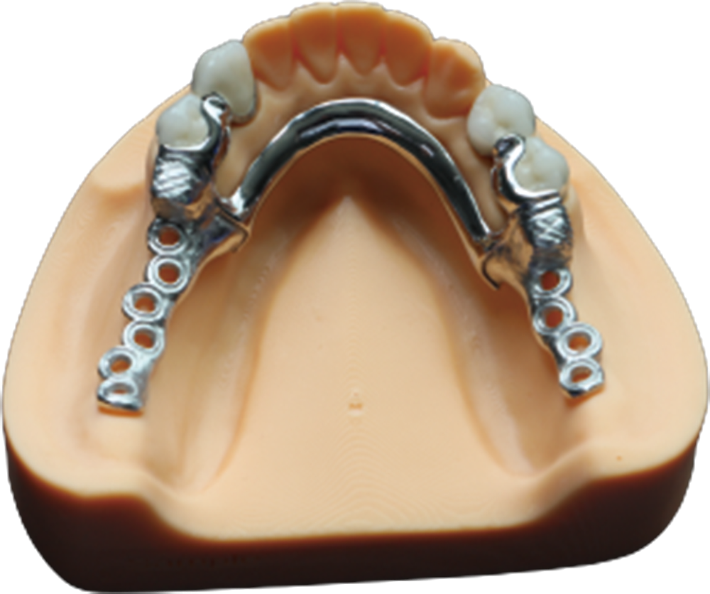 Bar-supported removable attachment example