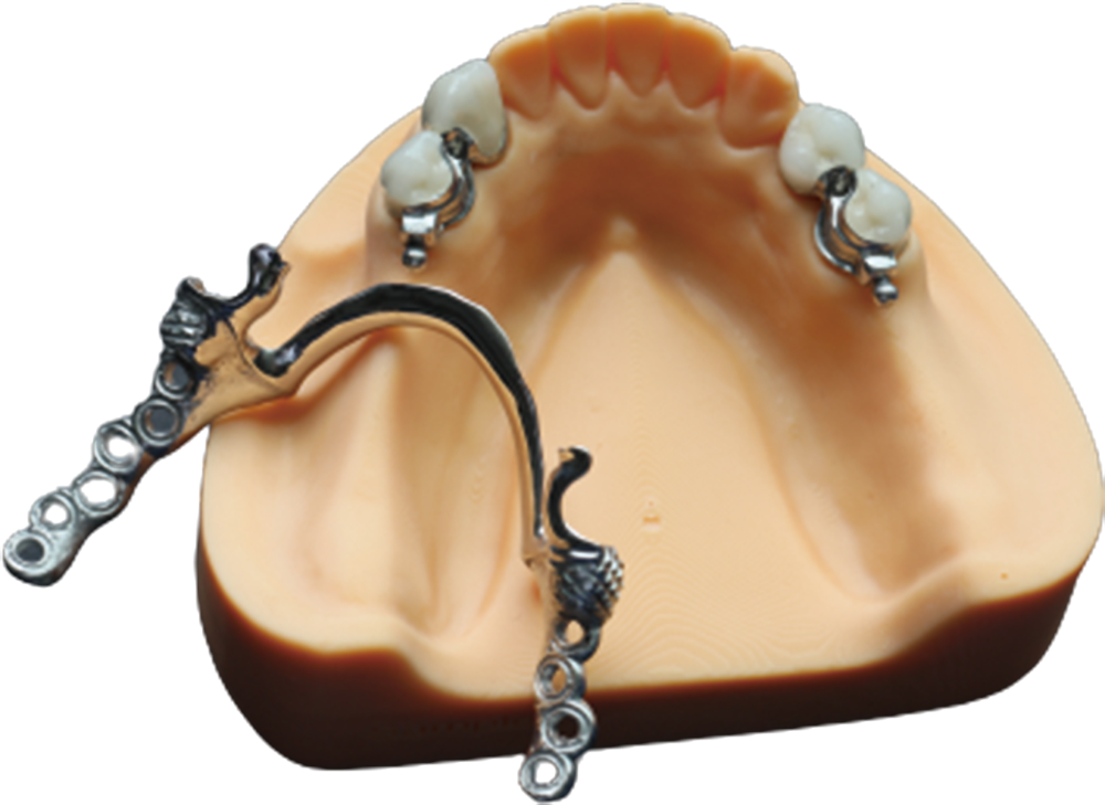 Customized removable attachment example