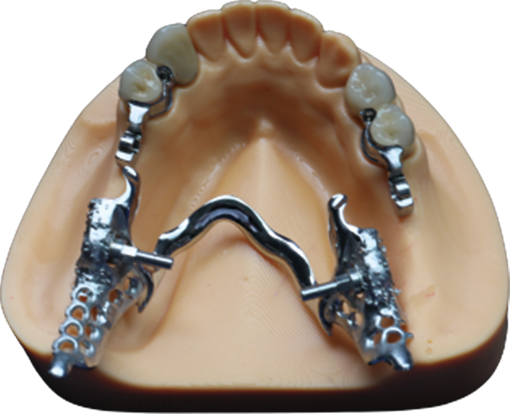 Implant attachment removable example