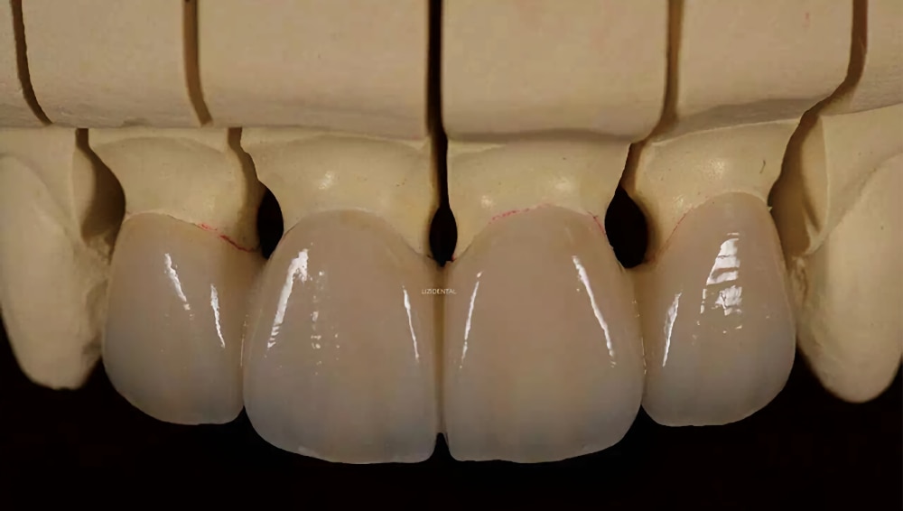 IPS e.max anterior restoration example