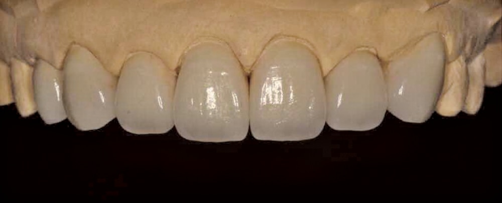 IPS e.max veneer and anterior case example