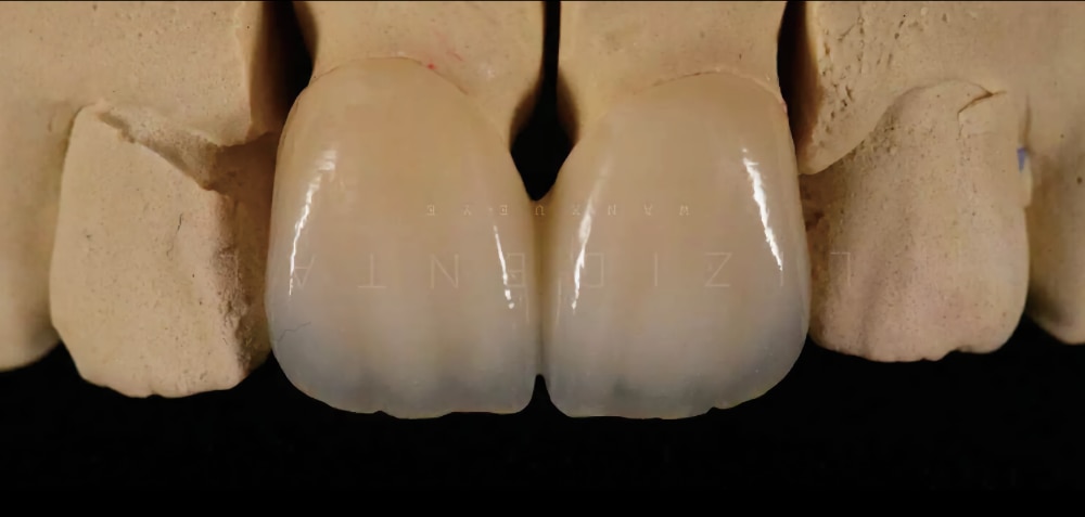 IPS e.max crown detail example