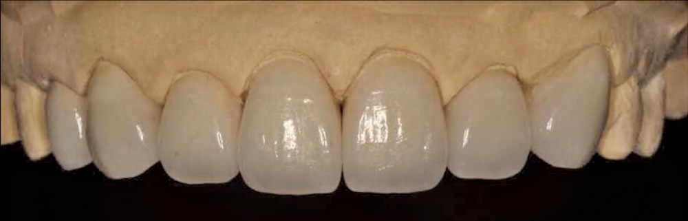 IPS e.max inlay or onlay case example