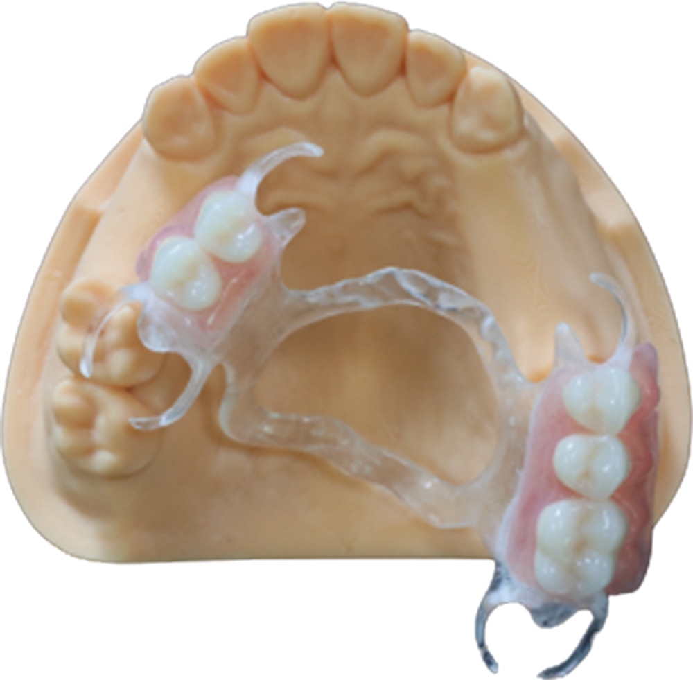 Flexible denture example three