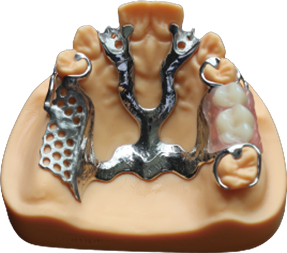 Cast removable framework example