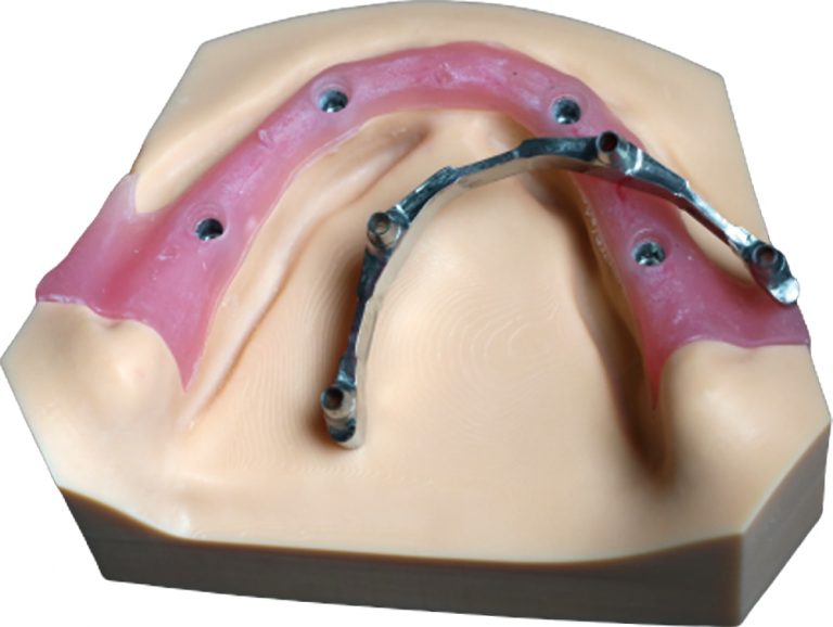 Legacy implant bar side profile example