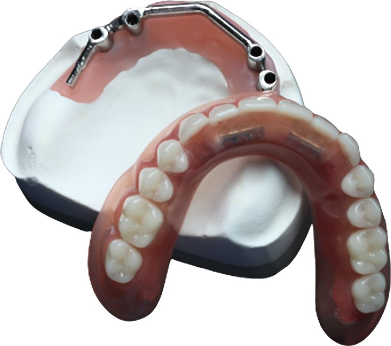 Legacy implant bar anterior support example