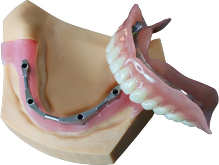 Legacy implant bar seating example