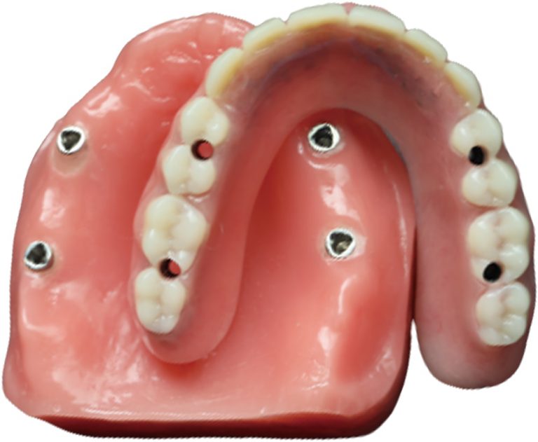 Legacy implant bar connector example
