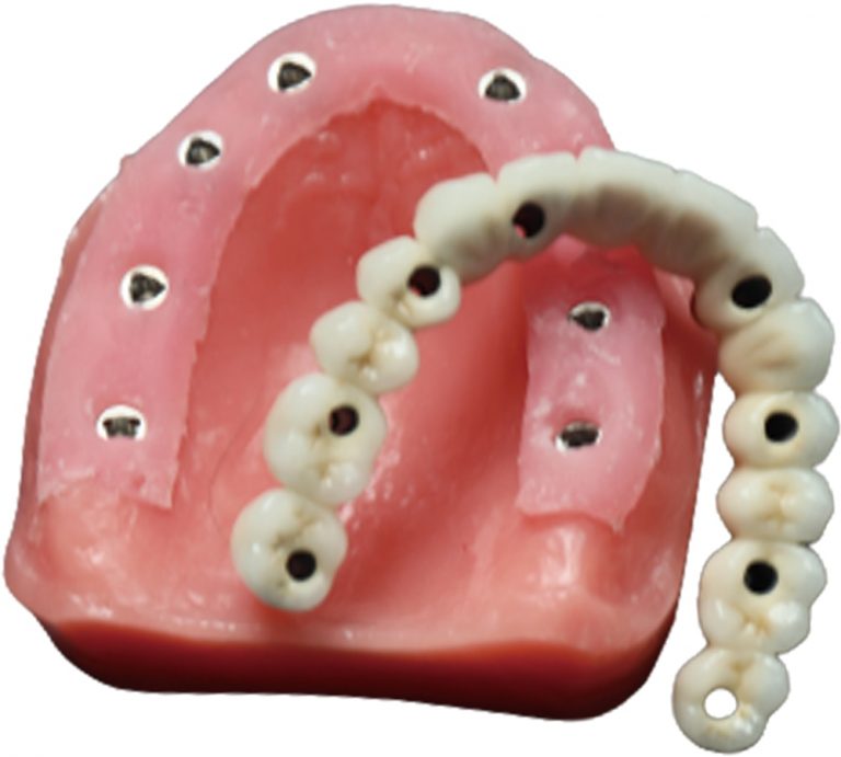 Legacy implant bar precision frame example
