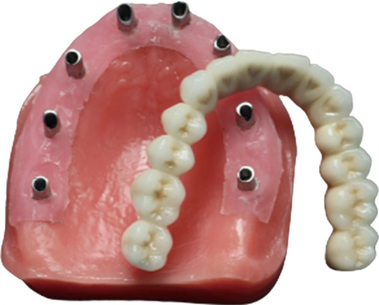 Legacy implant bar full framework example
