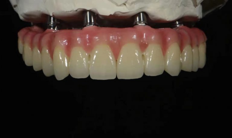 Legacy implant bar overview example