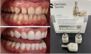 Dentsply Sirona Celtra Duo shade and clinical result reference