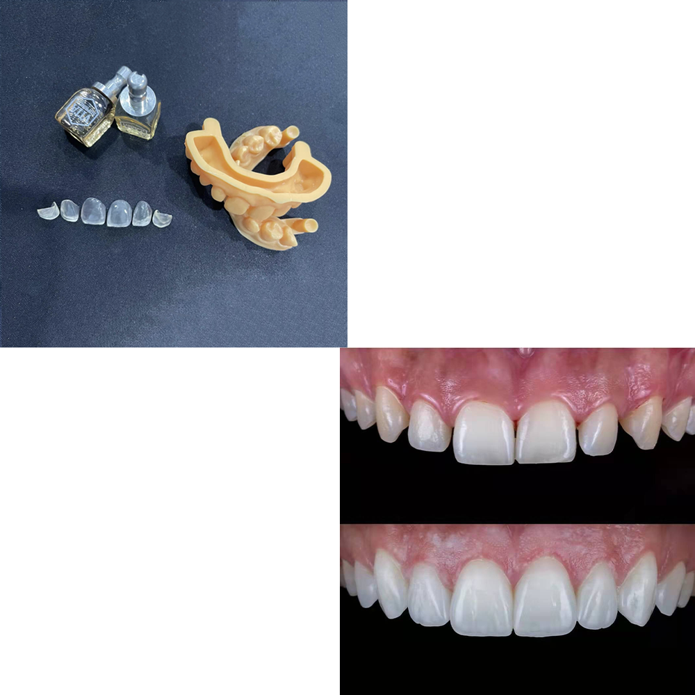 VITA SUPRINITY clinical restoration reference