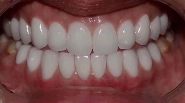 After treatment, case 1