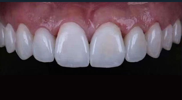 After treatment, case 3
