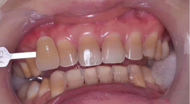 Before treatment, case 1