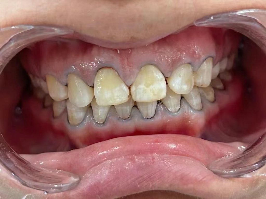 Before treatment, case 6