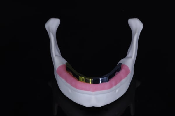 Implant overdenture restorative contour example