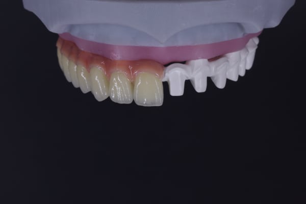 Implant overdenture full prosthetic view example