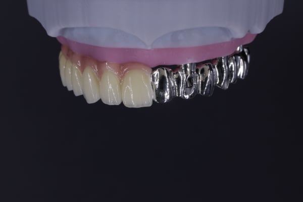 Implant overdenture tissue side example