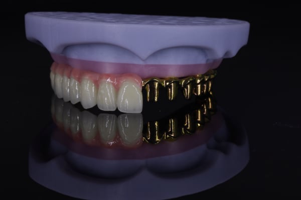 Implant overdenture attachment example