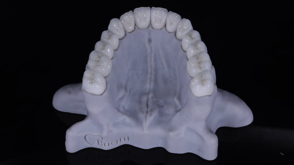 All-ceramic restoration model