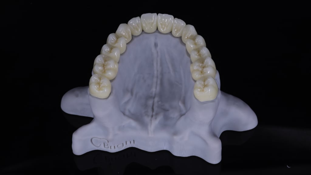 Veneer DSD Smile Design example