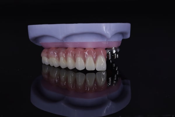 Implant overdenture side seating example