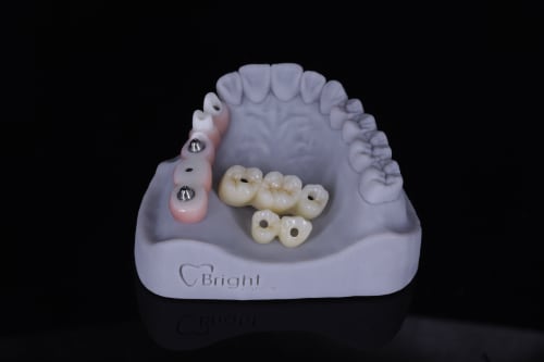 Implant Custom Abutment example