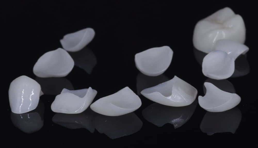 Monolithic zirconia restorative example