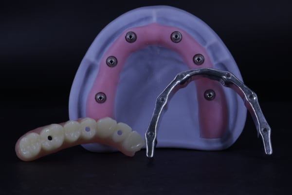 Implant bar tissue side profile example