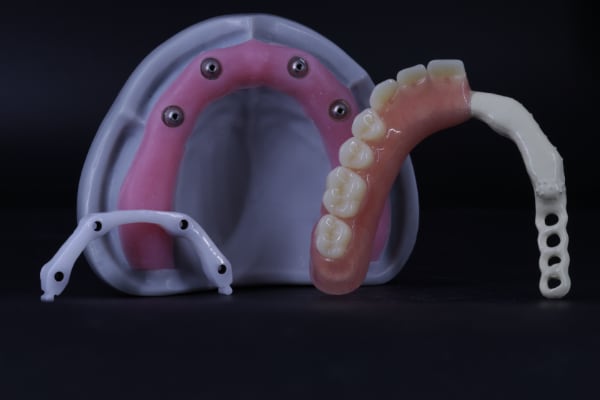 Implant overdenture full arch example