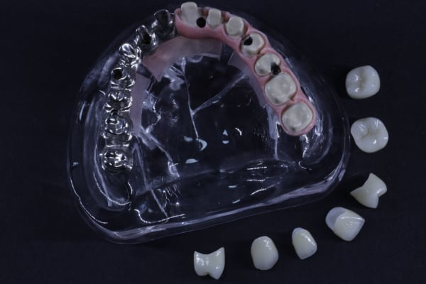 Implant bar hybrid framework example