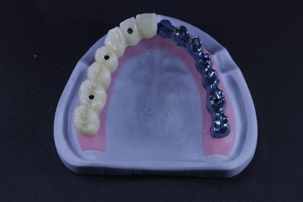 Implant bar full arch support example