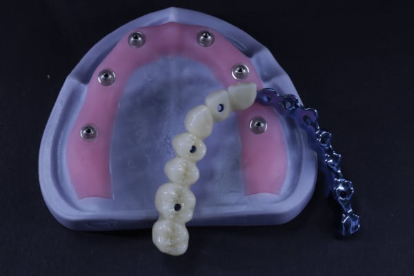 Implant bar retention window example