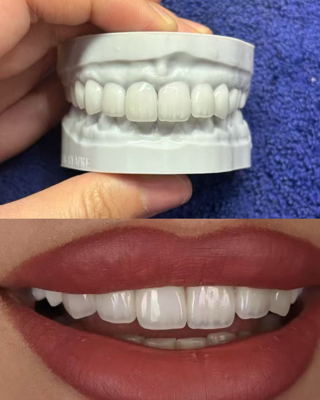 Completed ceramic veneer restoration