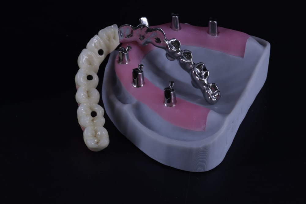 Implant bar framework fit example