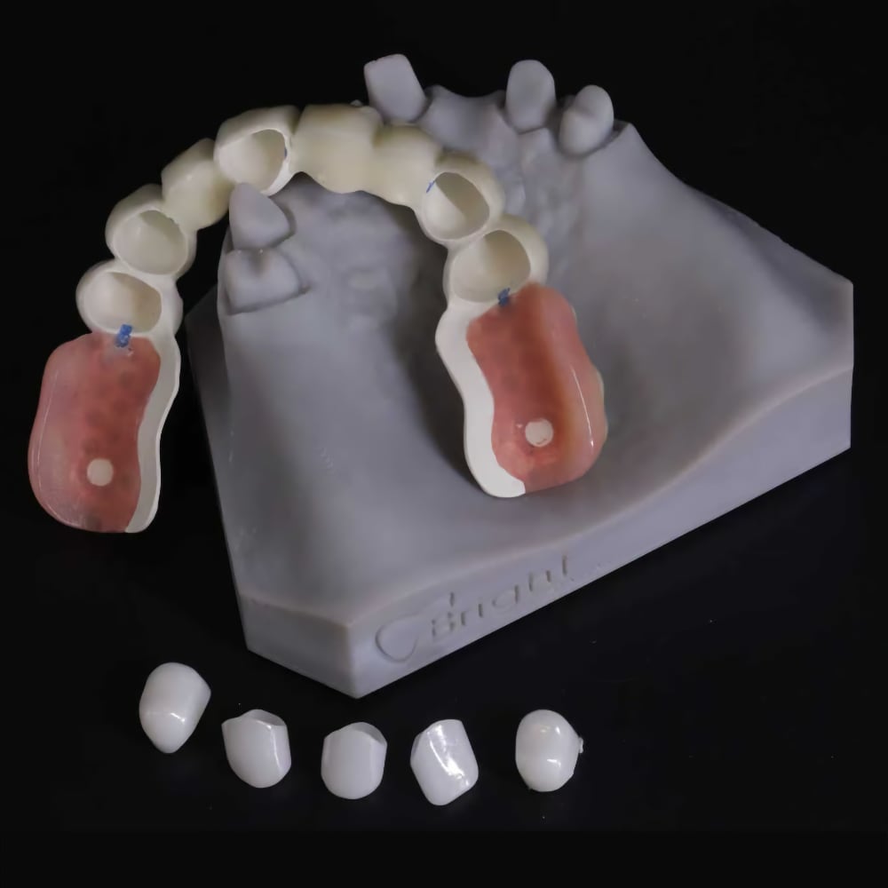 Flexible denture example two