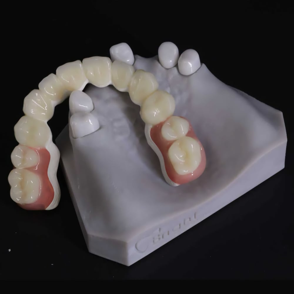 Flexible denture example four