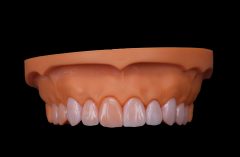 NEW CAD VENEERS