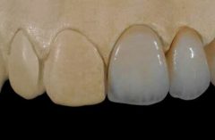 PFM / Snap-On Smile