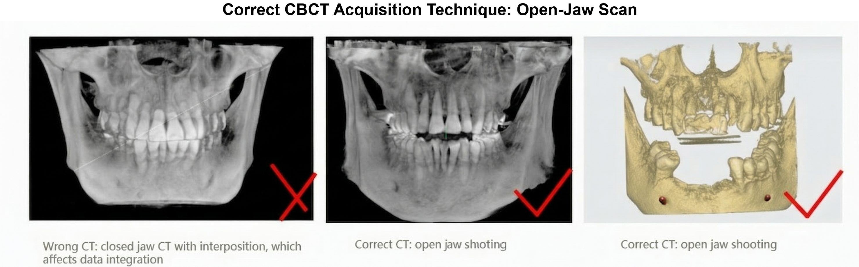 Correct CBCT acquisition technique open-jaw scan reference