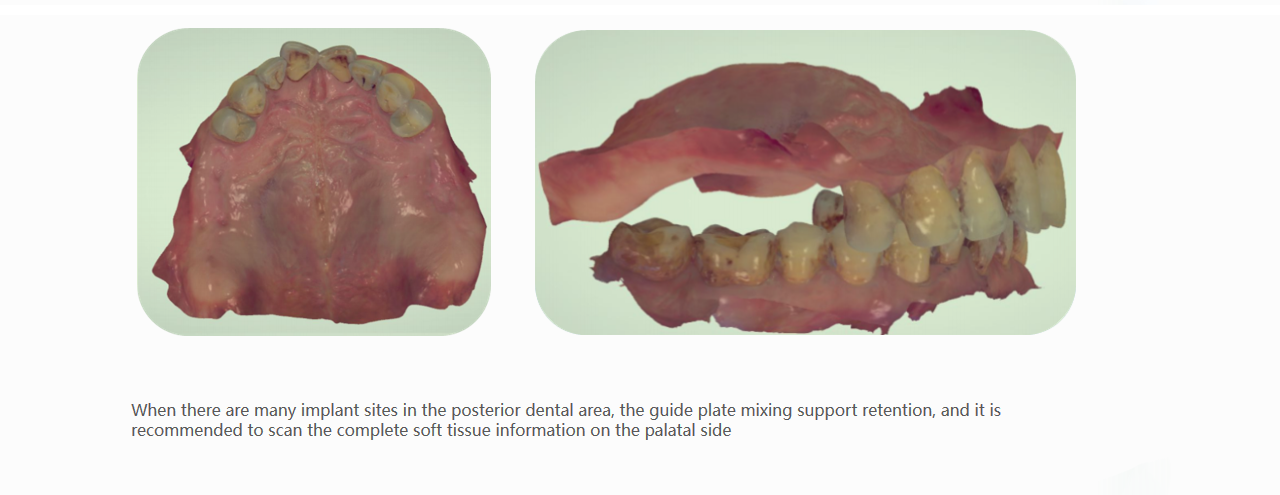 Intraoral model data requirements posterior scan reference