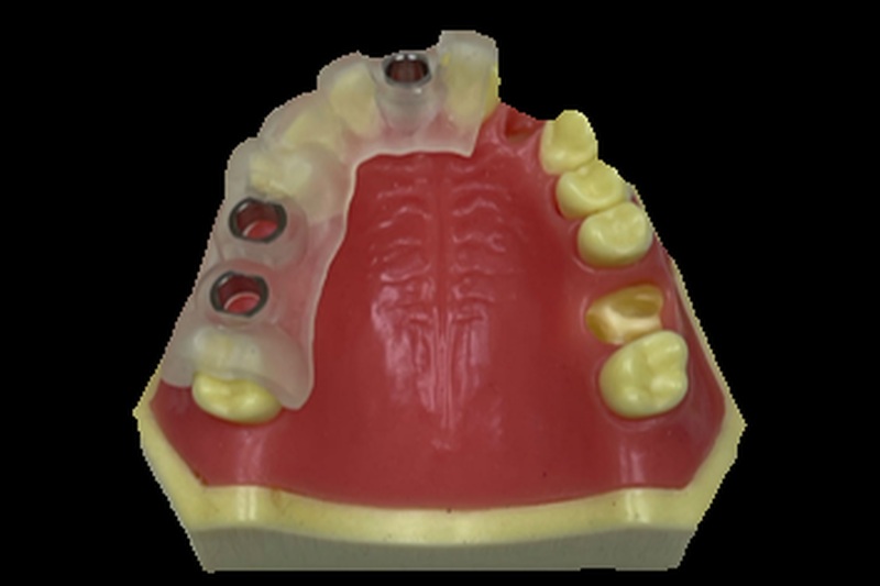 Implant Surgical Guide