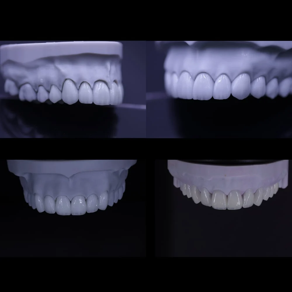 NEW CAD VENEERS