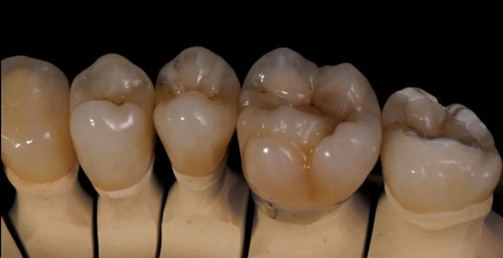 PFM / Snap-On Smile